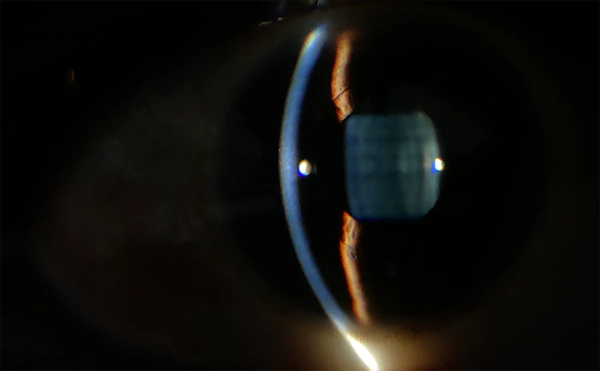 Remidio PSL D20 | Captura