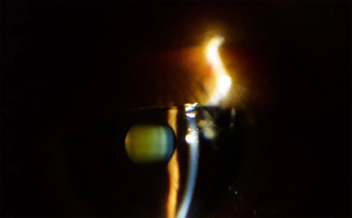 Remidio PSL D20 | Captura