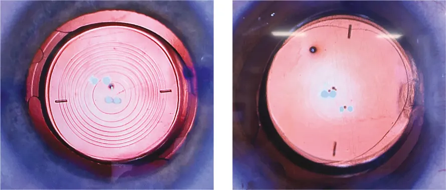 Figura F. Imágenes microscópicas de una LIO tórica trifocal difractiva (izquierda) y la LIO tórica Galaxy (derecha) – Cortesía del Sr. Allon Barsam.